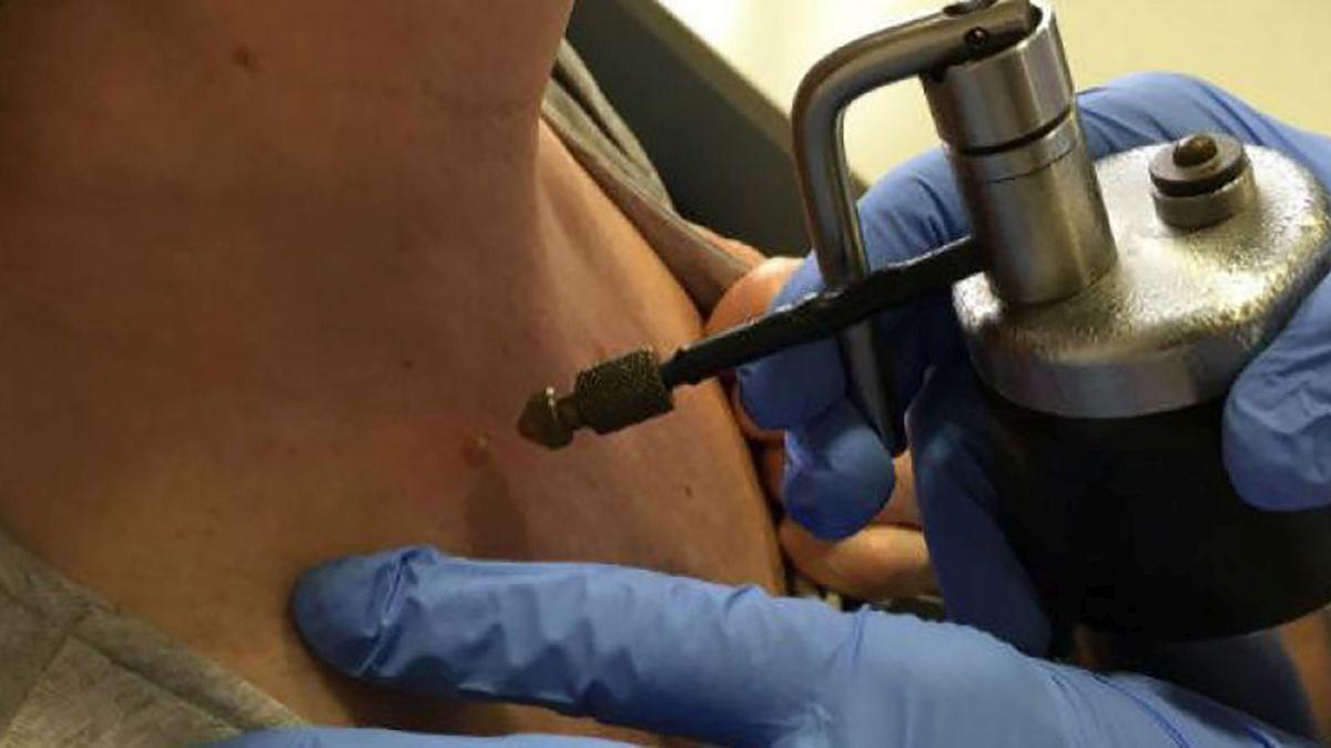 crioterapia_verrugas.jpg