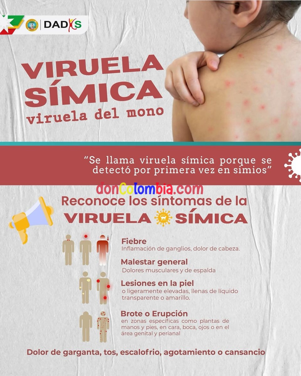 Ojo con el MPOX viruela símica con las sexoservidoras